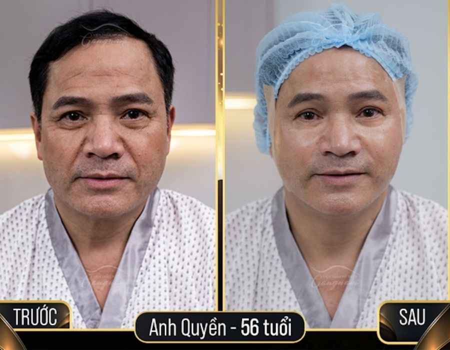 Hình ảnh trước và sau khi căng chỉ Collagen Gold Fiber mắt