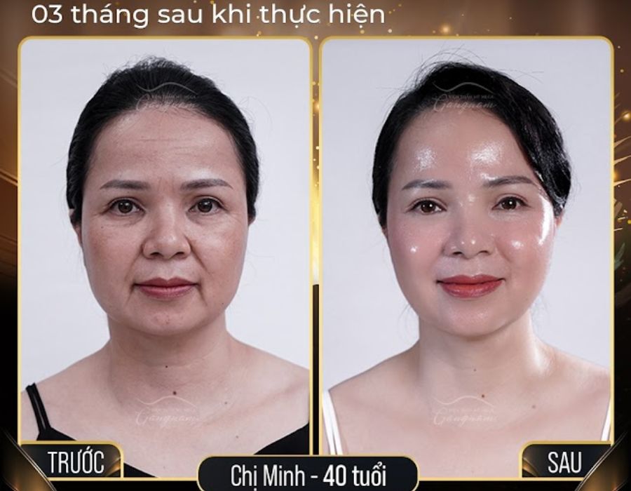 Chị Minh trước và sau khi thực hiện Collagen Gold Fiber