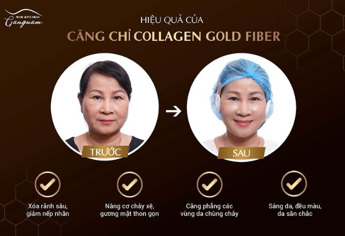 Hiệu quả của dịch vụ căng chỉ Collagen Gold Fiber