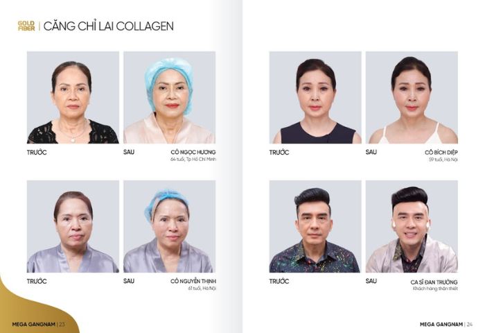 Hình ảnh khách hàng thực hiện phương pháp căng chỉ rãnh miệng - Collagen Gold Fiber tại Mega Gangnam