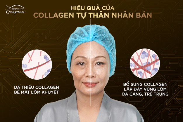 Hình ảnh trước vào sau khi thực hiện cấy collagen tự thân nhân bản ở một nửa bên mặt
