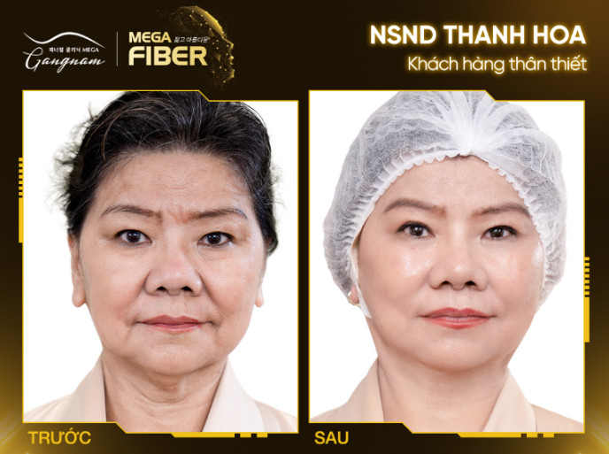 NSND Thanh Hoa trước và sau khi thực hiện Mega Fiber vùng cổ và toàn mặt