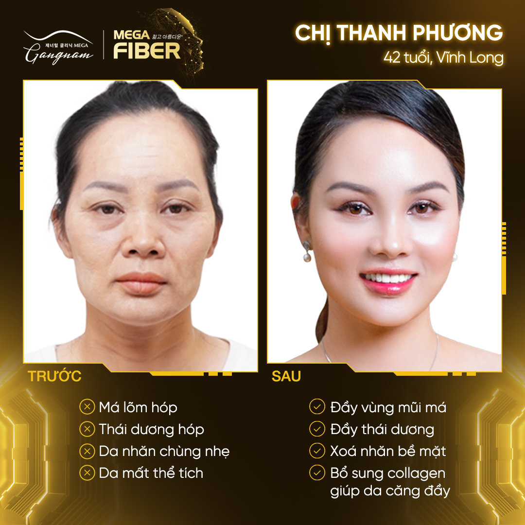 Chị Thanh Phương có nhiều khác biệt trên gương mặt trước và sau khi thực hiện liệu trình Mega Fiber 