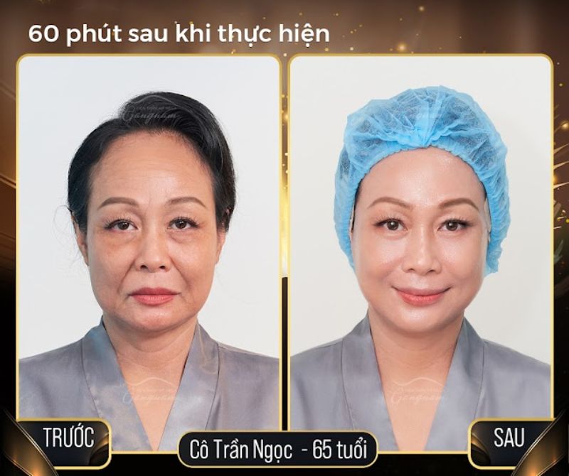 Hình ảnh cô Trần Ngọc sau liệu trình 60 phút cấy chỉ collagen