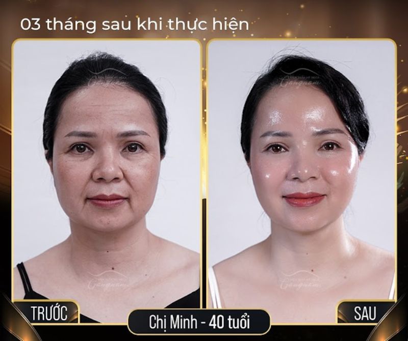 Làn da của chị Minh trở nên căng bóng và tươi trẻ hơn sau 3 tháng thực hiện căng chỉ Collagen Gold Fiber