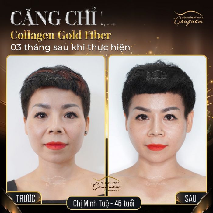 Công dụng của cấy chỉ thẩm mỹ