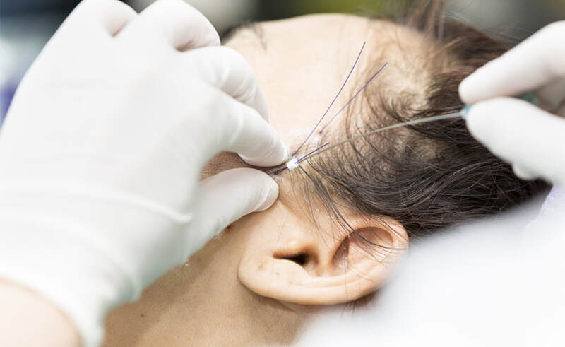 Vùng da sát mang tai dễ gây ảnh hưởng tới phần tóc khi thực hiện căng chỉ 