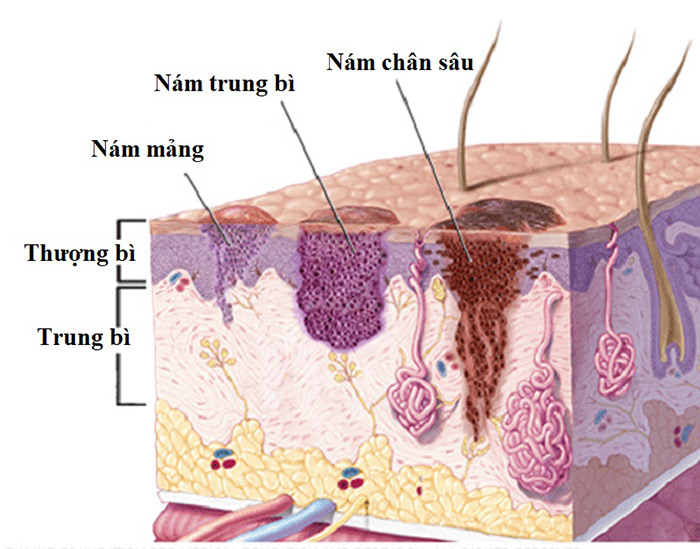 Nám chân sâu xuất hiện sắc tố ở lớp trung và hạ bì của da 