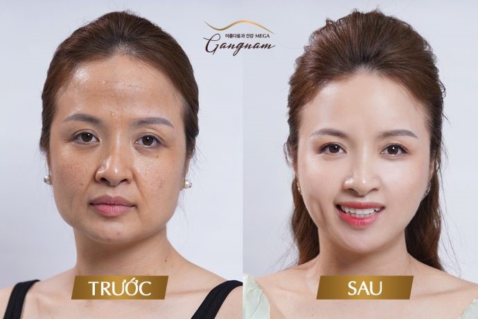 Kết quả trước và sau khi thực hiện căng da mặt bằng chỉ tại Mega Gangnam