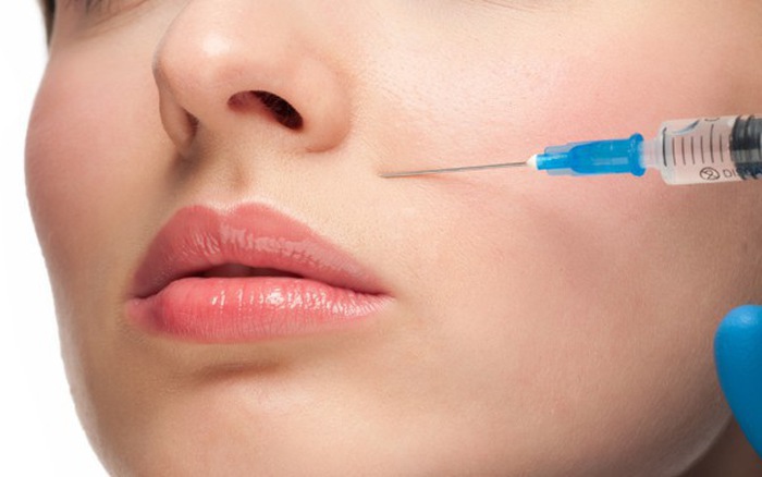 Tiêm filler làm đầy rãnh nhăn tuy hiệu quả rõ nhưng chỉ duy trì được thời gian ngắn