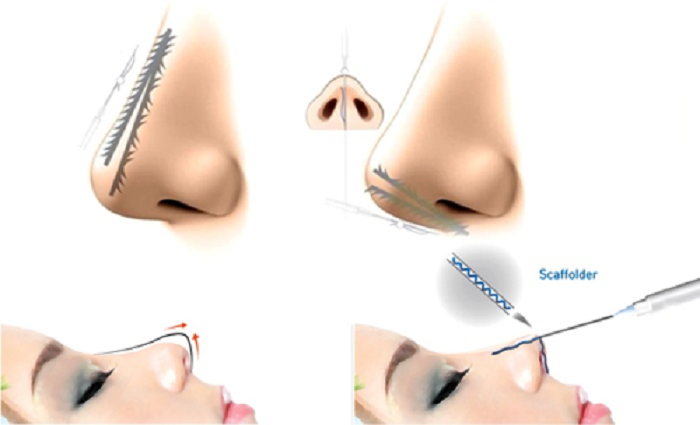 Chỉ sinh học Misko chủ yếu được dùng trong việc nâng cao dáng mũi, làm đẹp 