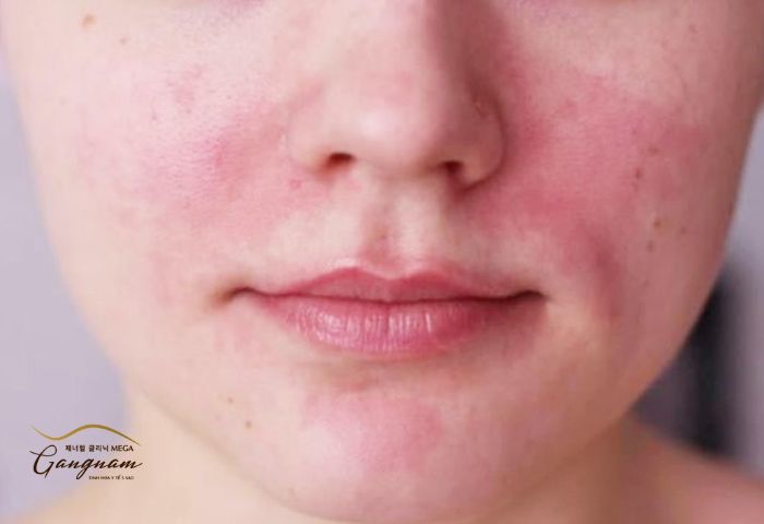Căng da mặt ở đâu tốt để hạn chế biến chứng có thể xảy ra