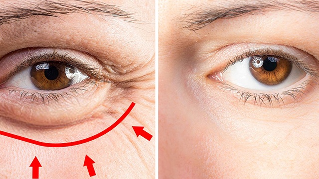 Giảm nếp nhăn vùng mắt có thể dùng các nguyên liệu tự nhiên