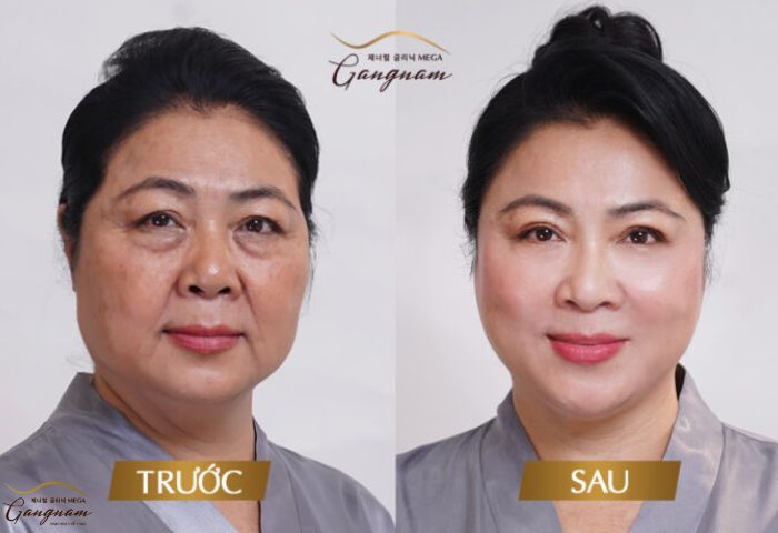 Khắc phục mặt chảy xệ triệt để với căng chỉ Collagen Fiber Gold tại Mega Gangnam