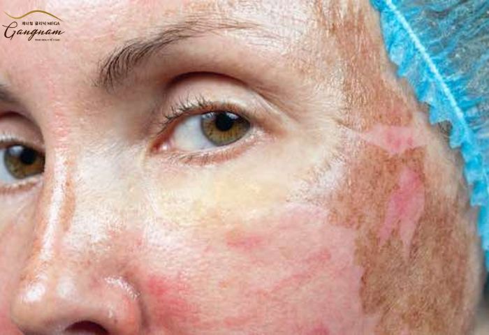 Những tác dụng phụ có thể gặp khi peel da