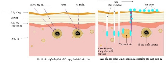 Quy trình thực hiện quá trình lăn kim trên bề mặt da 