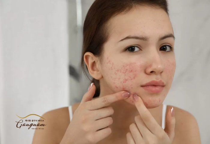 Những cách chăm sóc da và kiểm soát mụn đơn giản tại nhà