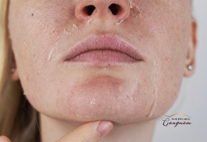 Peel da mặt có thể gây ra một số phản ứng phụ tùy vào loại hình peel