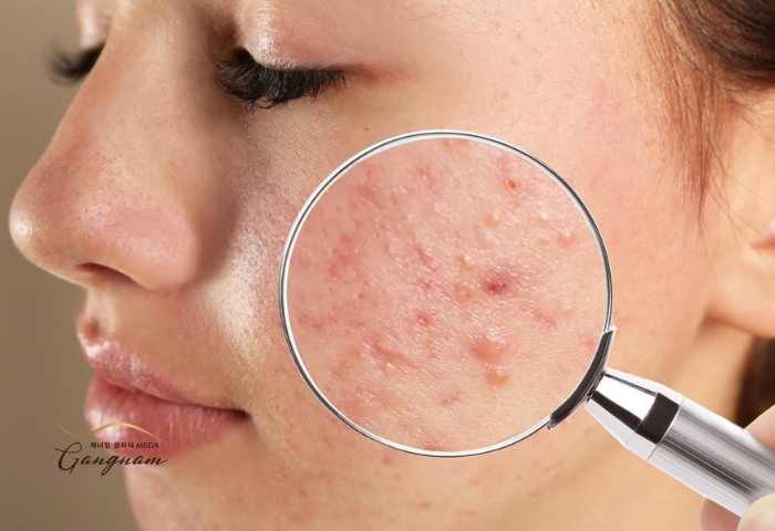 Những loại mụn có thể áp dụng phương pháp peel để cải thiện