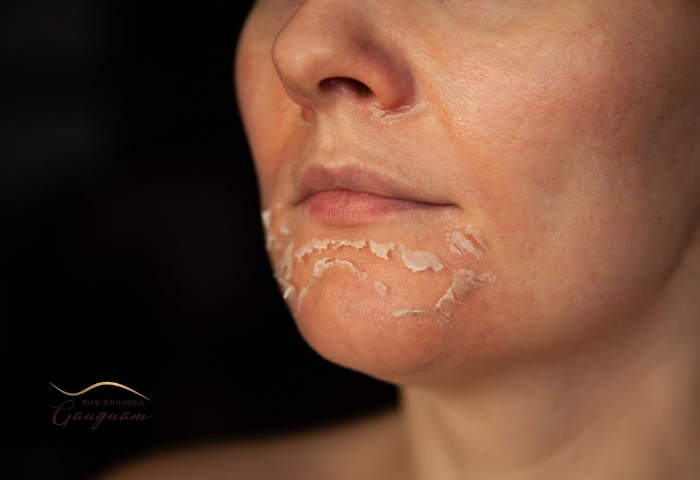 Những biểu hiện tiêu cực của làn da sau khi thực hiện lột da mặt