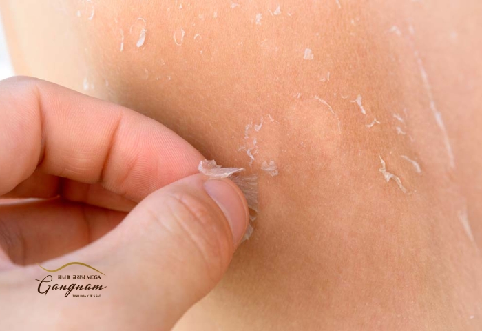 Những nguyên nhân chính khiến da mặt bị bong tróc cần chăm sóc cẩn thận