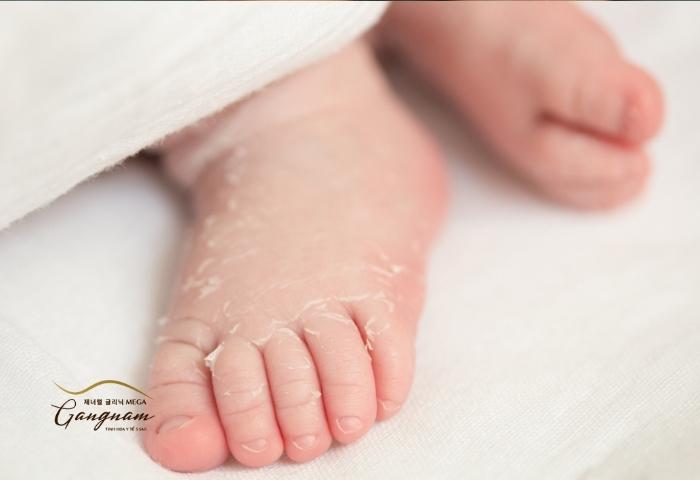 Tróc da tay chân thường nguy hiểm hơn ở người già và trẻ nhỏ